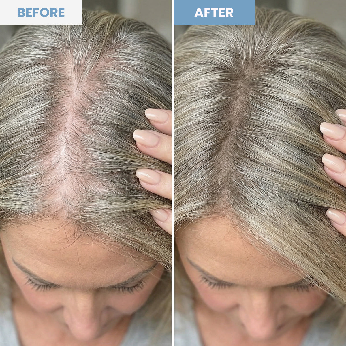 Split image showing a womans scalp before and after using a hair product; the before side shows thinning hair, while the after side shows fuller, thicker hair with less visible scalp.